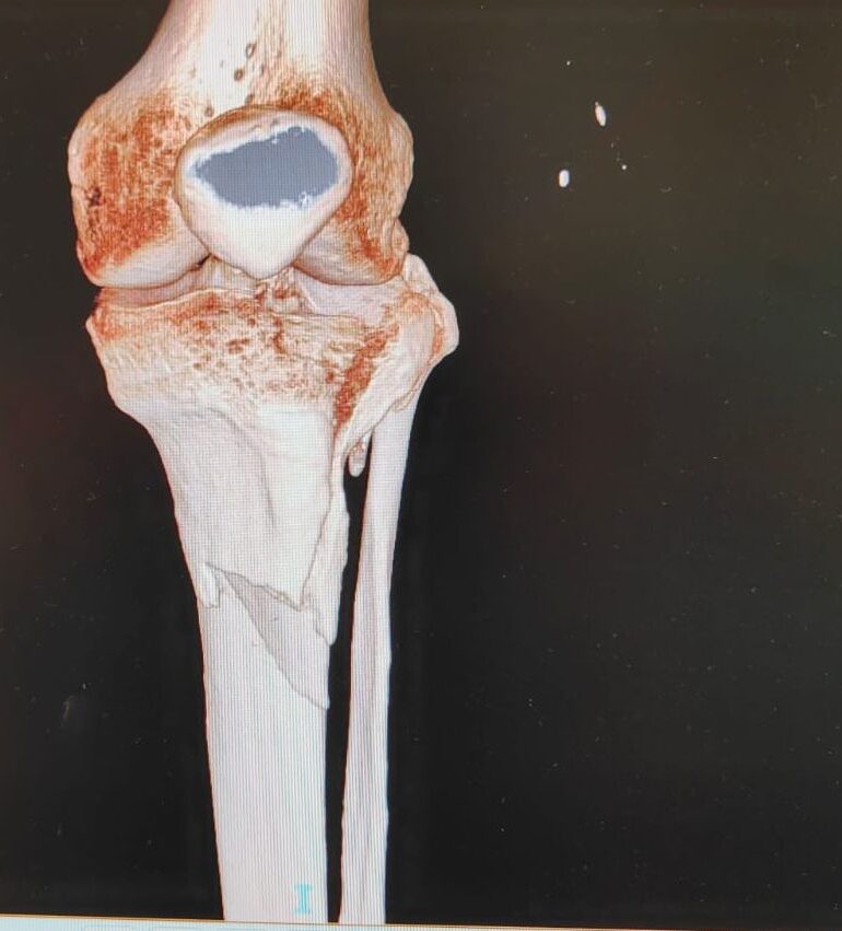 storie di successo clinica sanatrix roma frattura tibiale scomposta trattamento osteosintesi dopo