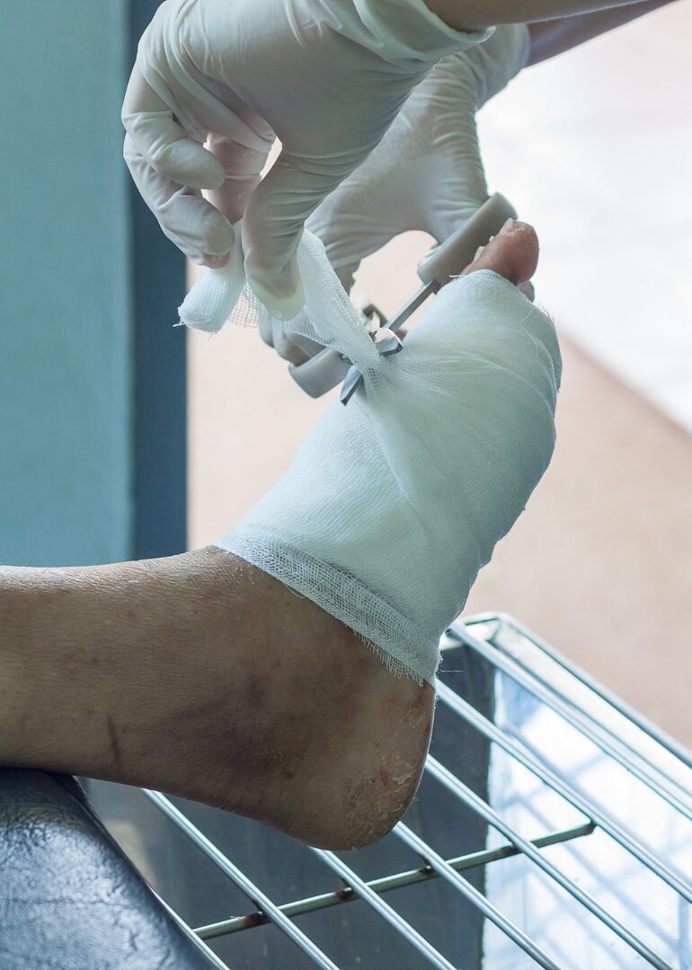 apertura nuova divisione diagnosi e trattamento piede diabetico roma clinica sanatrix Prof. Andrea Panunzi