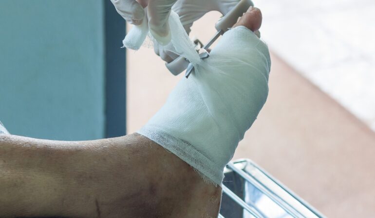 apertura nuova divisione diagnosi e trattamento piede diabetico roma clinica sanatrix Prof. Andrea Panunzi