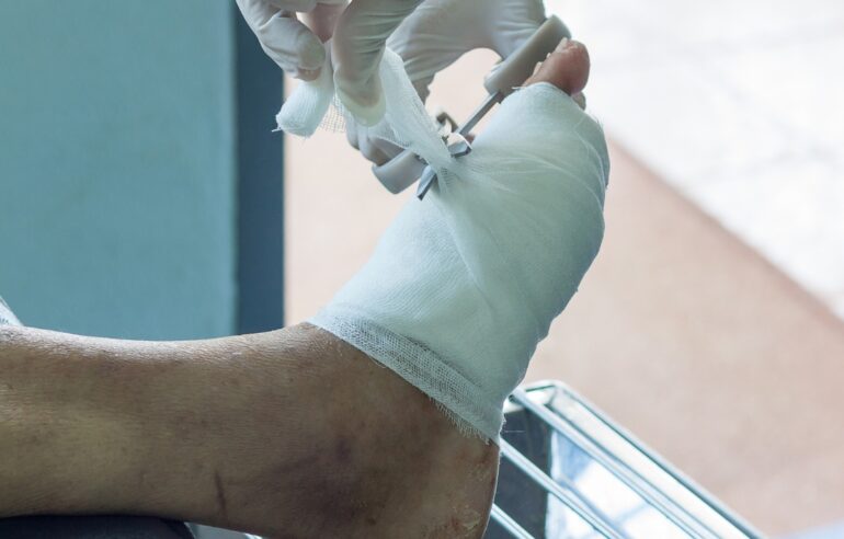 apertura nuova divisione diagnosi e trattamento piede diabetico roma clinica sanatrix Prof. Andrea Panunzi