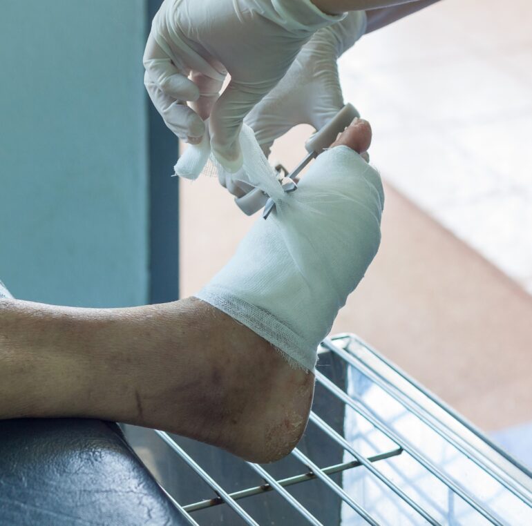 apertura nuova divisione diagnosi e trattamento piede diabetico roma clinica sanatrix Prof. Andrea Panunzi