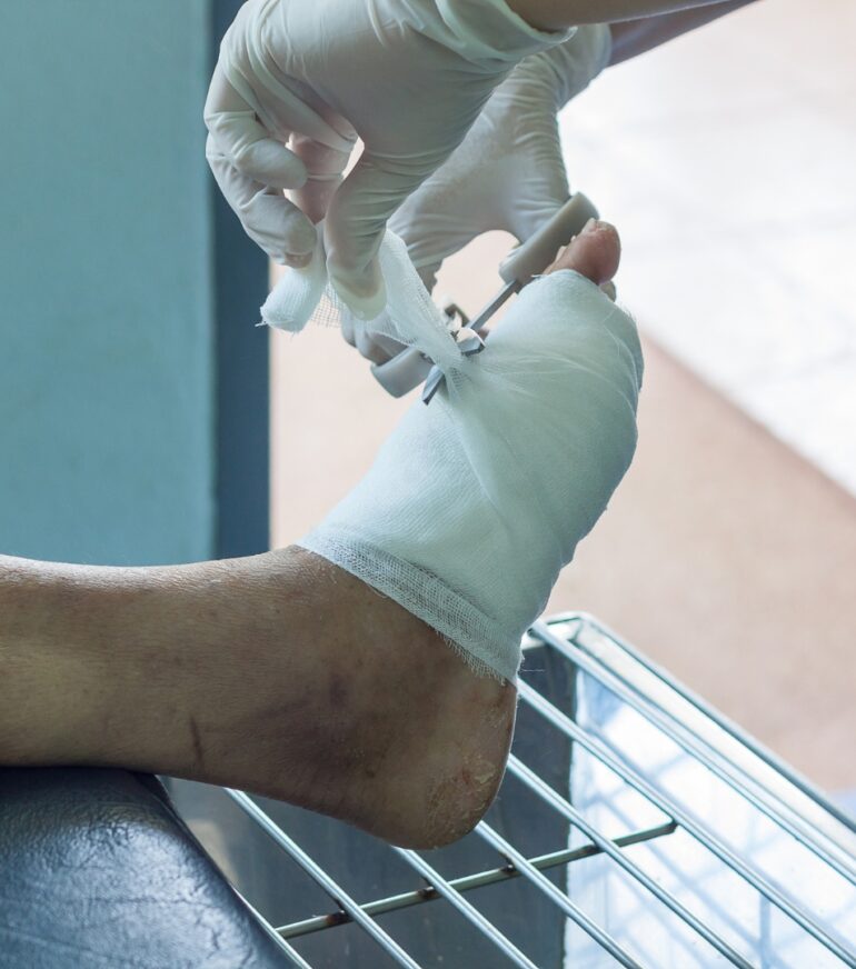 apertura nuova divisione diagnosi e trattamento piede diabetico roma clinica sanatrix Prof. Andrea Panunzi